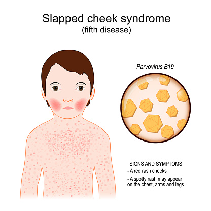 fifth disease